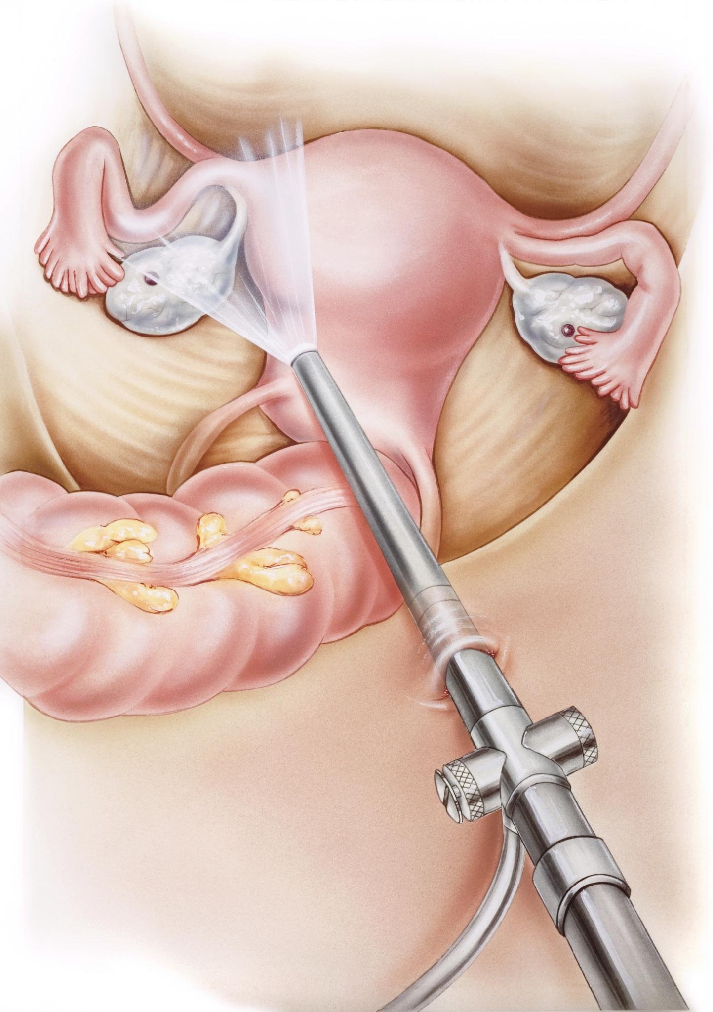 Laparoscopic.jpeg
